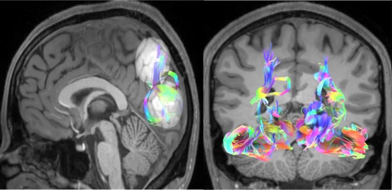 Immagine in risonanza magnetica di un cervello durante attività videoludica
